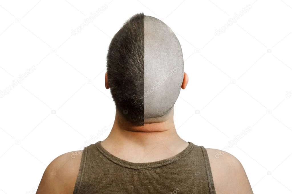 Man before and after hair loss, transplant on a isolated background. back view