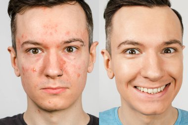 Öncesinde ve sonrasında iki adam. Sivilceli, kırmızı benekli, sorunlu, sağlıklı derili, sağlak bir adam. Sivilce tedavisi kavramı