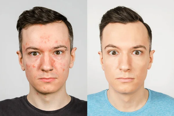 Two guys before-after: left guy with acne, red spots, problem skin, right guy with healthy skin. Acne treatment concept — Stock Photo, Image