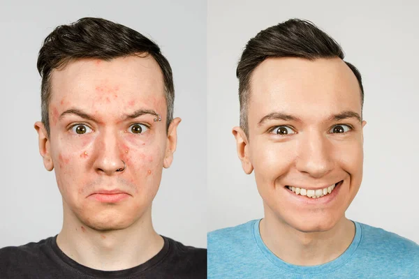 Dos chicos antes-después: chico izquierdo con acné, manchas rojas, piel problemática, chico derecho con la piel sana. Concepto de tratamiento del acné —  Fotos de Stock