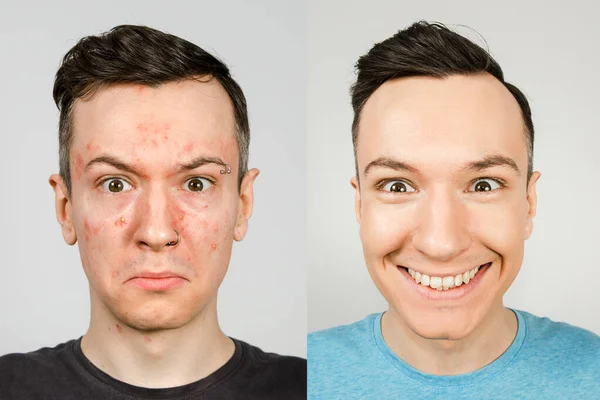 Dos chicos antes-después: chico izquierdo con acné, manchas rojas, piel problemática, chico derecho con la piel sana. Concepto de tratamiento del acné —  Fotos de Stock