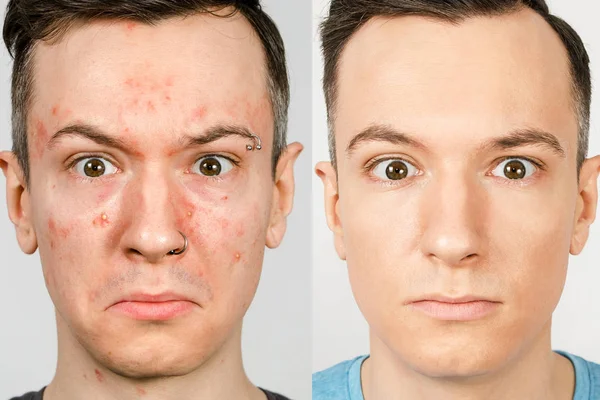 Dua orang sebelum-sesudah: pria kiri dengan jerawat, bintik merah, kulit masalah, pria kanan dengan kulit yang sehat. Konsep perawatan aktif — Stok Foto