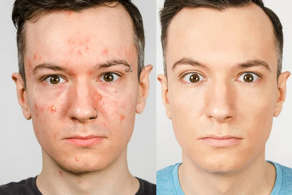 Dua orang sebelum-sesudah: pria kiri dengan jerawat, bintik merah, kulit masalah, pria kanan dengan kulit yang sehat. Konsep perawatan aktif — Stok Foto