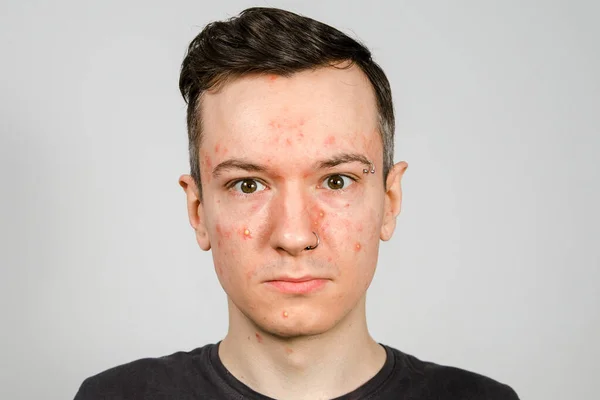 Guy with red spots and acne on his face with problem skin at the reception at the beautician — ストック写真