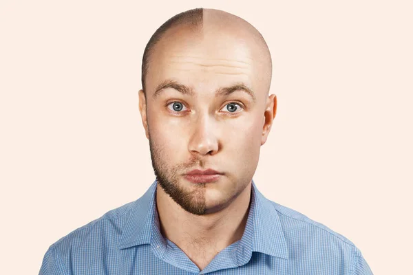 Hombre antes y después de la pérdida de cabello, trasplante en el fondo — Foto de Stock