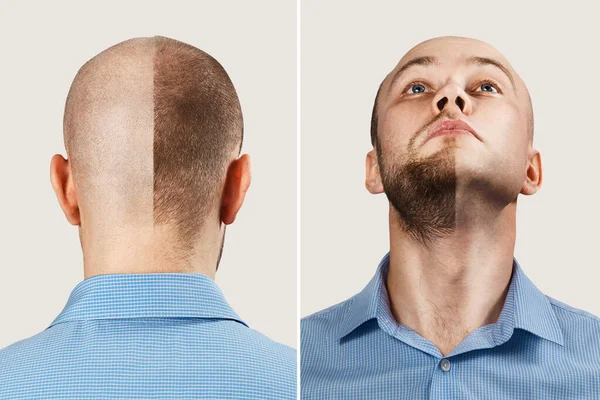 Lycklig man före och efter håravfall, alopeci. begreppet skallighet: den första mannen foto framför, den andra - bakom — Stockfoto