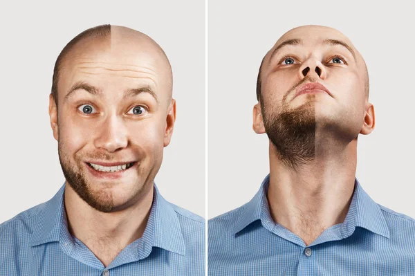 Saç dökülmesinden önce ve sonra mutlu adam, saç dökülmesi. Kellik konsepti: Öndeki ilk adam, arkadaki ikinci adam. — Stok fotoğraf
