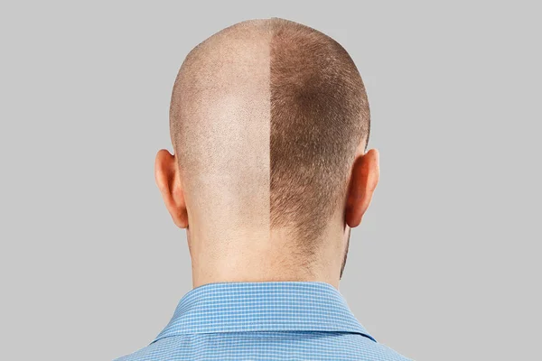 Man before and after hair loss, transplant on background. back view — 스톡 사진