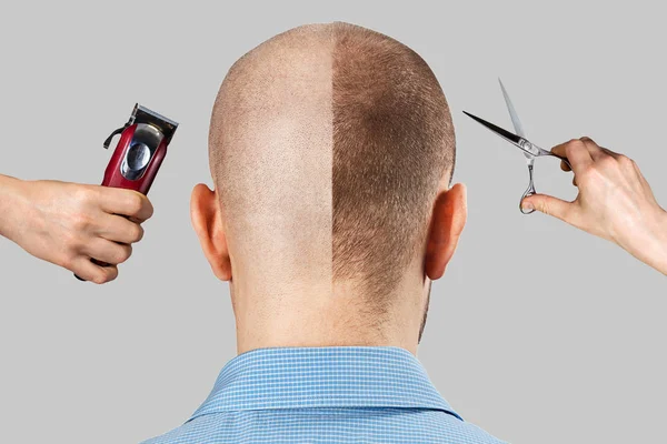 Saç kaybından önce ve sonra bir adam, arka planda derat tıraş makinesi ve makas ile nakil. arka plan — Stok fotoğraf