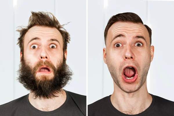 Sakallı Saçı Dökülmemiş Bir Adam Traş Olmadan Nakilden Önce Sonra — Stok fotoğraf