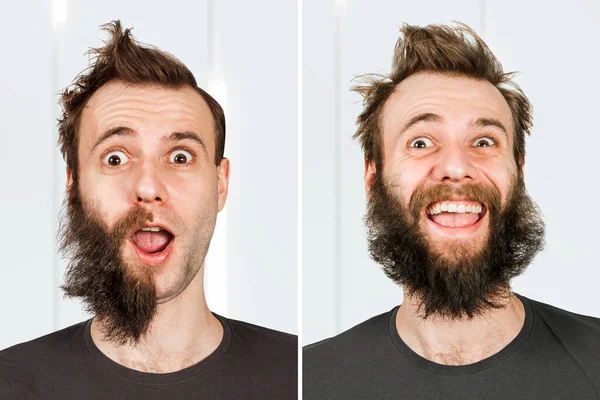 Happy Guy Half Beard Hair Loss Man Shave Transplant Haircut — Stock Photo, Image