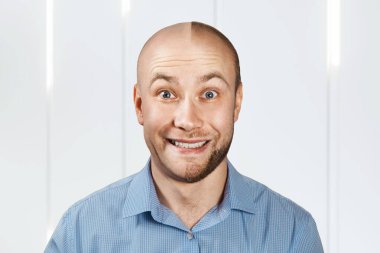 Saç dökülmesinden önce ve sonra portre adam, nakil. Kişiliği böl