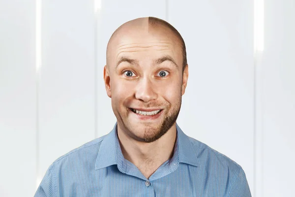 Retrato Homem Antes Depois Perda Cabelo Transplante Personalidade Dividida — Fotografia de Stock