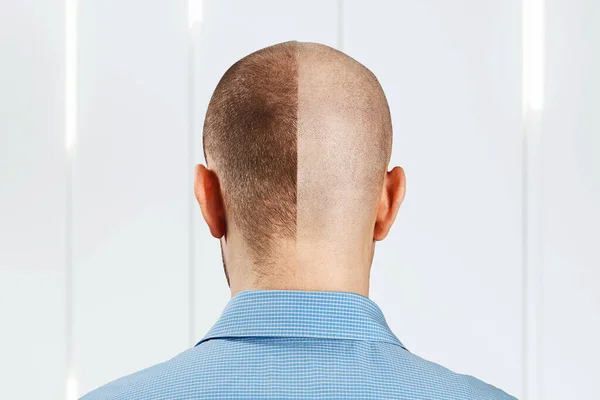 Retrato Hombre Antes Después Pérdida Cabello Trasplante Personalidad Dividida Vista —  Fotos de Stock