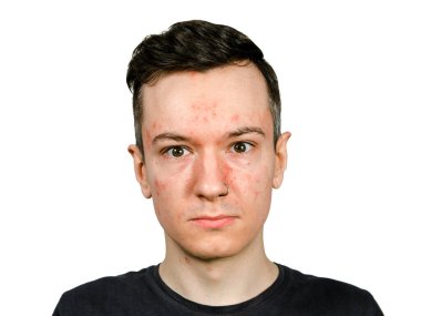 Alerjisi olan, kırmızı yüzlü, izole edilmiş bir adam portresi..