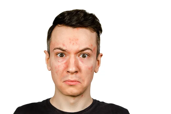 Портрет Молодого Человека Аллергией Красным Лицом Изолированный — стоковое фото