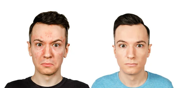 Alerjisi Olan Kırmızı Yüzlü Bir Gencin Portresi Zole Önce Adam — Stok fotoğraf