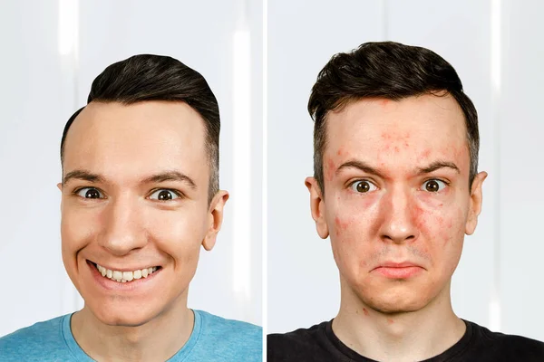 Retrato Jovem Com Alergia Com Cara Vermelha Homem Antes Depois — Fotografia de Stock