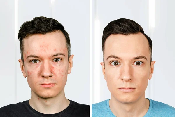 Retrato Joven Con Alergia Con Cara Roja Hombre Antes Después —  Fotos de Stock
