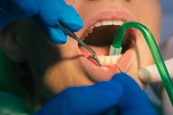 Closeup Exame Dental Limpo Sobre Dentes Uma Mulher Consultório Odontológico — Fotografia de Stock