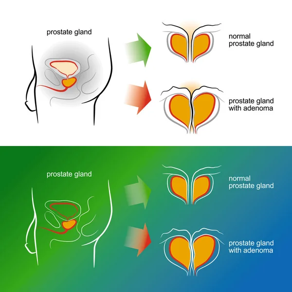 A férfi prosztata adenoma a vázlatot. Vektoros illustratio — Stock Vector