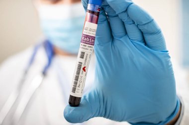 Kuduz virüsü bulaşmış kurgusal bir test tüpü kan örneğini elinde tutan bir doktorun görüntüsü..
