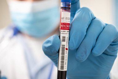 HlV / AIDS virüsü taşıyan hayali bir test tüpü kan örneğini elinde tutan bir doktorun görüntüsü.
