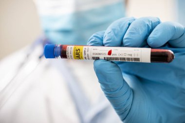 SARS koronavirüsüne yakalanmış kurgusal bir test tüpü kan örneğini elinde tutan bir doktorun görüntüsü..