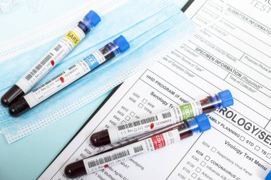 Laboratuvar raporu ve koruyucu maskesi olan çeşitli virüslü kurgusal kan örnekleri..