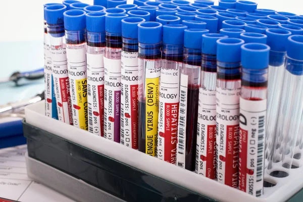 几个虚构的带有各种病毒的感染血液样本放在一个小瓶架上 — 图库照片