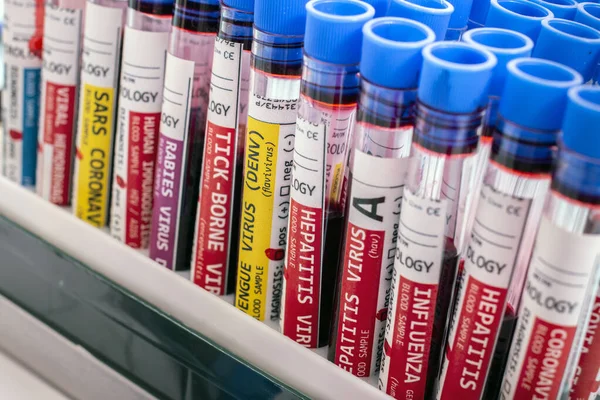 Několik Fiktivních Infikovaných Krevních Vzorků Různými Viry Stojanu Injekční Lahvičky — Stock fotografie