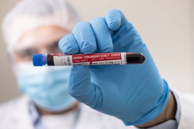 HlV / AIDS virüsü bulaşmış kurgusal bir test tüpü kan örneğini elinde tutan bir doktorun görüntüsü.