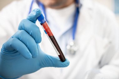 Bir doktorun elinde hayali bir test tüpü kan örneği tutarken görüntüsü, muhtemelen enfekte olmuş..