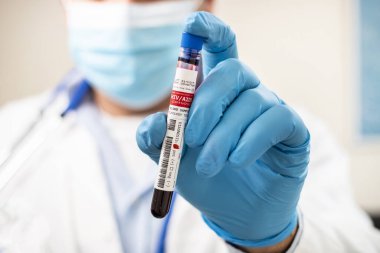 HlV / AIDS virüsü taşıyan hayali bir test tüpü kan örneğini elinde tutan bir doktorun görüntüsü.