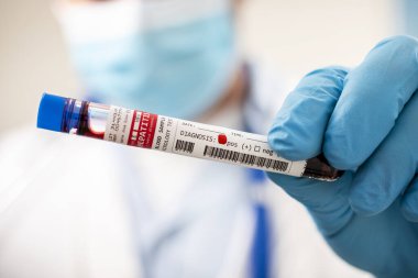 Elinde hayali bir test tüpü olan Hepatit E virüsü bulaşmış bir doktorun görüntüsü..