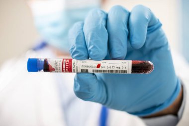 Doktorun elinde hayali bir test tüpü kan örneği tutarken Hepatit D virüsü bulaşmış..