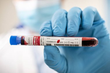 Doktorun elinde hayali bir test tüpü kan örneği tutarken Hepatit D virüsü bulaşmış..