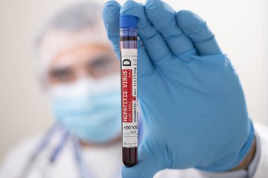 Doktorun elinde hayali bir test tüpü kan örneği tutarken Hepatit D virüsü bulaşmış..