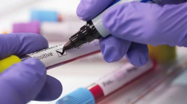 Coronavirus, COVID-19 kan testi makro yakın çekim. Coronavirus NCOV testi pozitif sonuç verdi. Tıbbi Görüntü. Kan testi konseptini işaretliyorum. SARS, MERS, FLU. Kırmızı kamerada yavaş çekim.