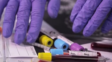 Coronavirus, COVID-19 kan testi makro yakın çekim. Coronavirus NCOV testi pozitif sonuç verdi. Tıbbi Görüntü. Kan testi konseptini işaretliyorum. SARS, MERS, FLU. Kırmızı kamerada yavaş çekim.