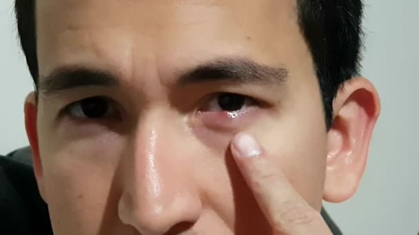 Närbild Person Som Frustrerade Med Återkommande Ögoninfektion Stye — Stockvideo