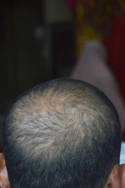 bald hair on the head
