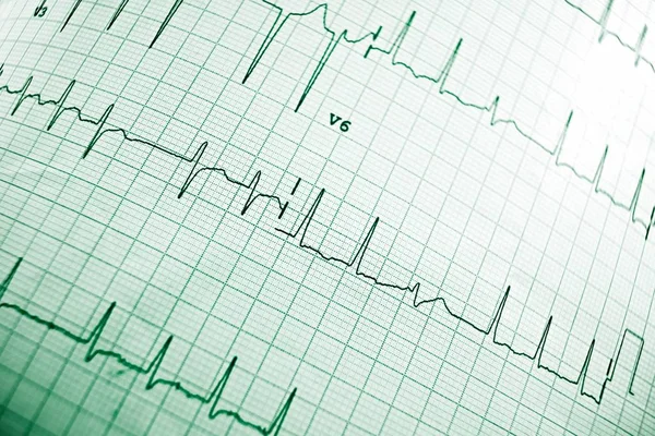 Électrocardiogramme en gros plan — Photo