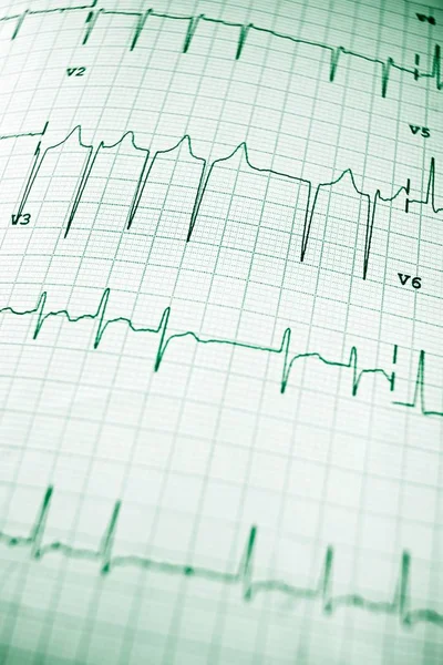 Eletrocardiograma de perto — Fotografia de Stock