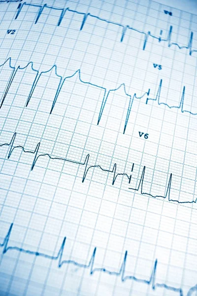 Électrocardiogramme en gros plan — Photo
