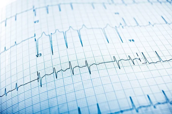 ELECTROCARDIOGRAMEN närbild — Stockfoto