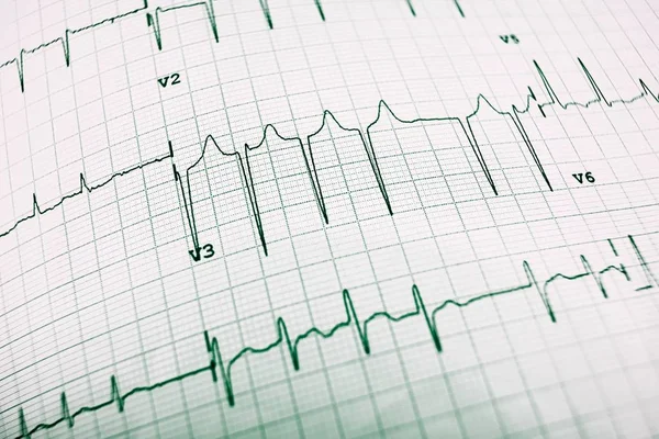 Électrocardiogramme en gros plan — Photo