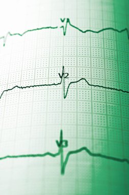 Elektrokardiyogramı kağıt formunda kapat.