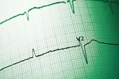 Elektrokardiyogramı kağıt formunda kapat.