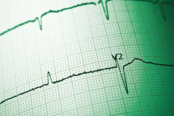 Nahaufnahme Eines Elektrokardiogramms Papierform — Stockfoto